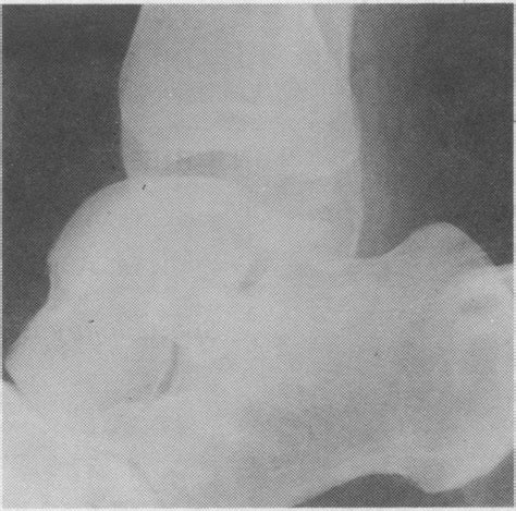 Stress X Ray Of Ankle Revealing Anterior Instability Right Ankle