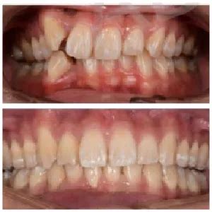 Teeth Braces Cost Types By Dental Clinic Karachi Side Effects