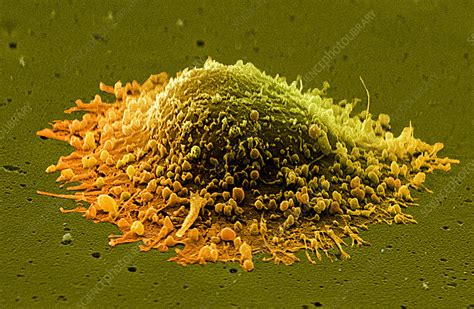 Prostate Cancer Cell SEM Stock Image M865 0162 Science Photo Library