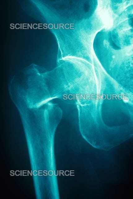 Hip Fracture and Osteoporosis, X-ray | Stock Image - Science Source Images