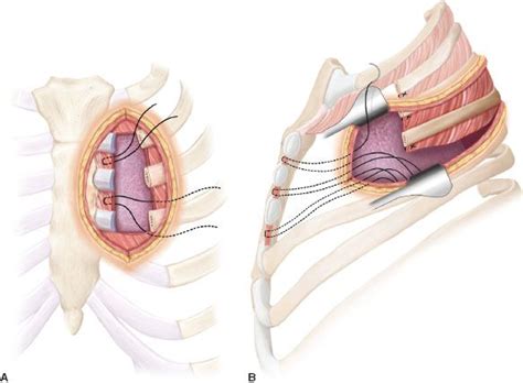 Chest Wall Resection/Reconstruction for Tumors | Thoracic Key