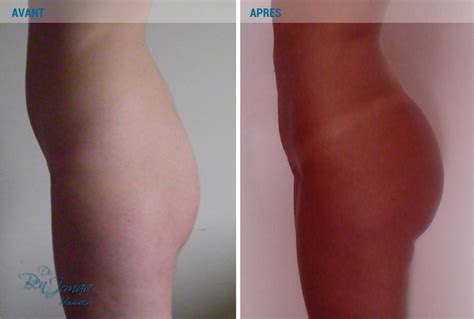 Portfolio Remodelage Des Fesses Dr Ben Jemaa