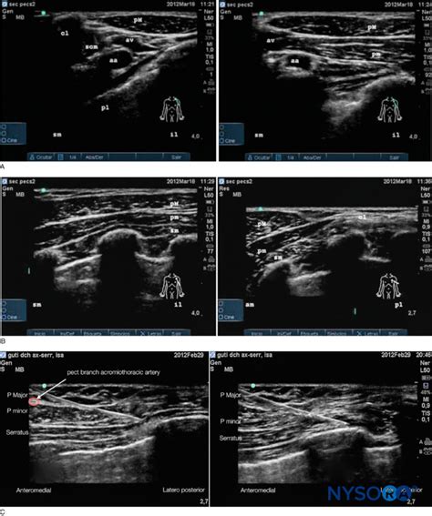 Regional Anesthesia Pecs Ii Sonogram NYSORA