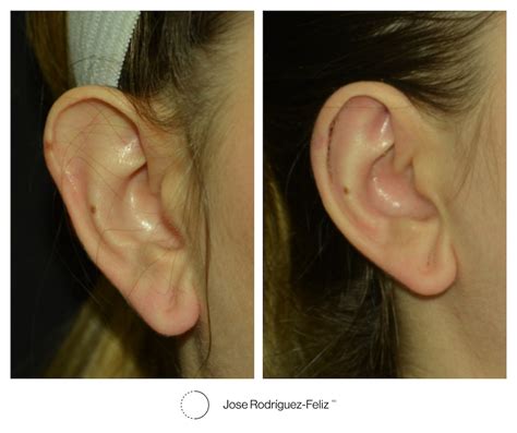 If You Have Ever Wanted Smaller Ears, Macrotia Ear Surgery Is For You