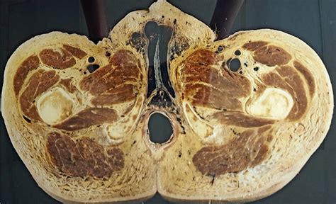 Pelvic Cadaver Through Ischial Tuberosity Diagram Quizlet