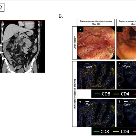 Clinicopathological Findings Of Colitis In Case A Computed