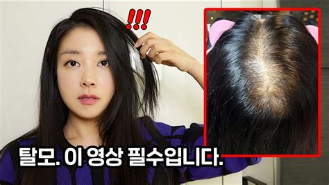 Eng 머리가 빠진다면 이 영상 꼭 보세요 탈모 극복하는법 완결판 How To Overcome Hair Loss The