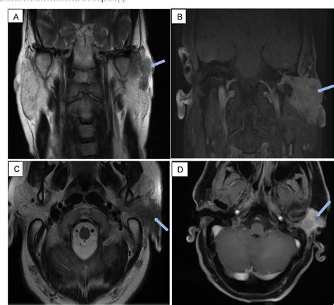 Figure 1 From Unusual Presentation Of Parotid Gland Adenoid Cystic