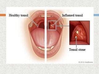 Nursing Management Of The Patient With Tonsillitis Ppt Ppt