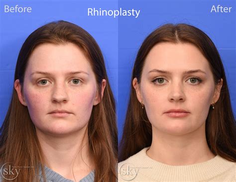 San Diego Rhinoplasty Specialist — Sky Facial Plastic Surgery