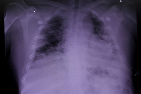 Lung damage found in COVID dead may shed light on 'long COVID': study