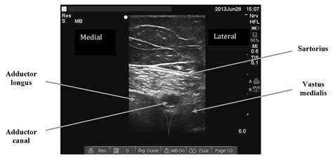 Adductor Canal Block Catheter