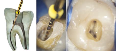 coronal preflaring style italiano endodontics
