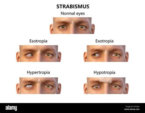 Strabismus types, computer illustration Stock Photo - Alamy