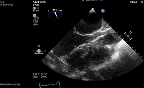 Axillary Intra Aortic Balloon Pump Migration Into The Left Ventricle