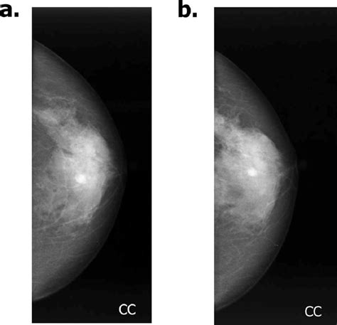 A Mammography Craniocaudal Cc Revealed A Well Defined Oval Shaped