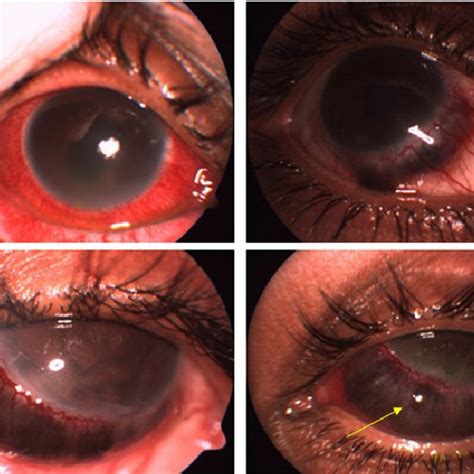 Severe Granulomatous Sclerouveitis With Inferior Thinning In Left Eye