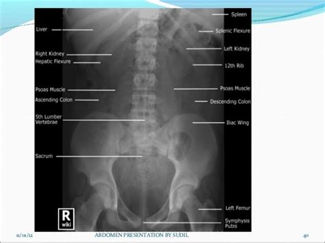 X Ray Abdomen Anatomy Anatomy Reading Source