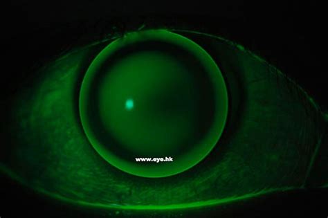 Specialty Contact Lenses Hong Kong Eye Hk Rgp Keratoconus Post