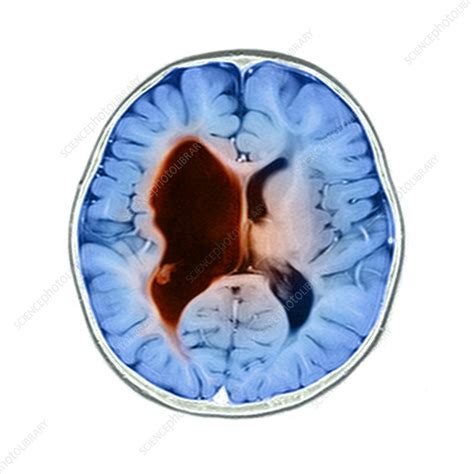 Cerebral palsy, MRI scan - Stock Image - M130/1022 - Science Photo Library