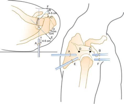 Advanced Shoulder Arthroscopy Essentials Musculoskeletal Key