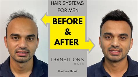 Watch This Before After Non Surgical Hair Systems For Men Sydney