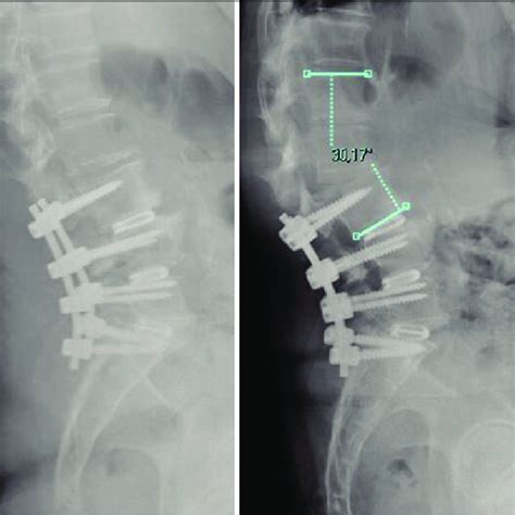 70 Year Old Female Patient Operated For Central And Foraminal Download Scientific Diagram