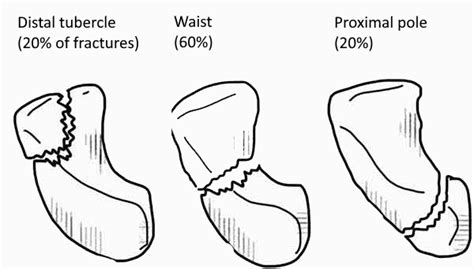 Scaphoid Fracture Classification