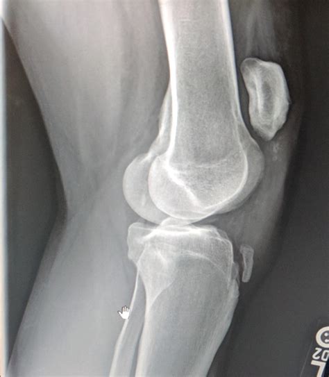 Ruptured patellar tendon - 3 years post surgery : r/Radiology