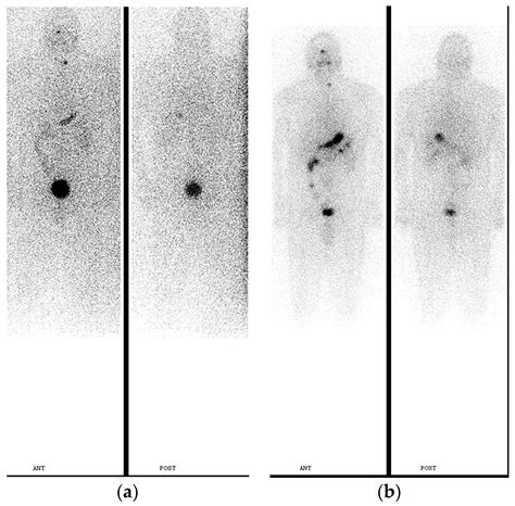 Jcm Free Full Text Pre Treatment And Post Treatment I 131 Imaging