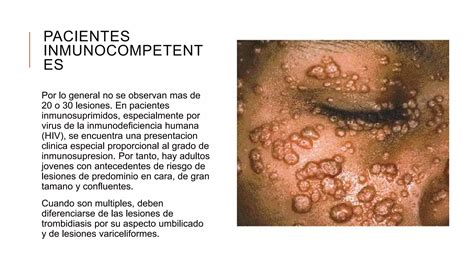 Molusco Contagioso PPT