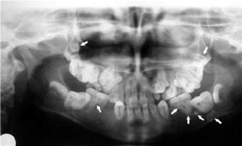 Panoramic Radiography Showing Bilateral Dental Twinning Anomalies And