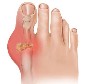 Gout Treatment in South Florida | Florida Foot & Ankle