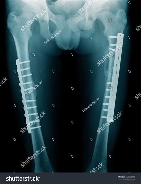 Xray Fixed Fracture Both Femur Bone Stock Photo (Edit Now) 562508818