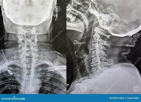 Plain X Ray Cervical Vertebrae Showing Straightening Of Cervical