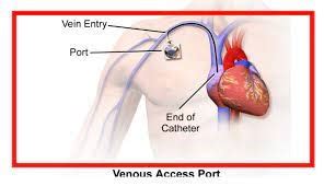 Totally Implanted Central Venous Access Device Portacath