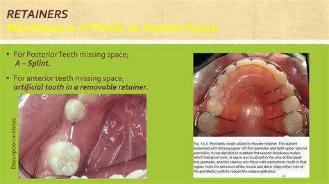 Retention In Orthodontics Dentistry Ppt Free Download