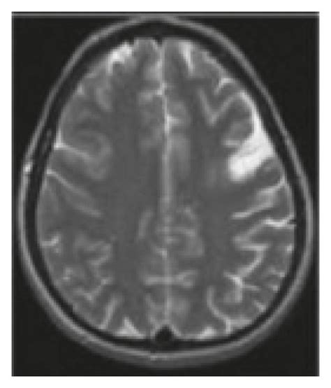 MRI image of cerebral infarction. | Download Scientific Diagram