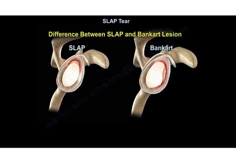 SLAP Tear — OrthopaedicPrinciples.com