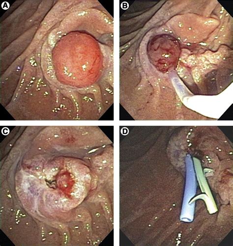 Endoscopic Ampullectomy Management Of Periampullaryduodenal Adenomas In Familial Adenomatous