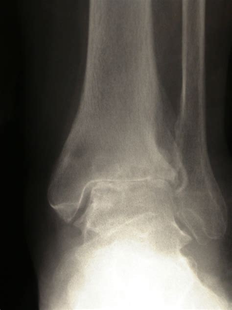 DSCN7997 - The Foot and Ankle Clinic