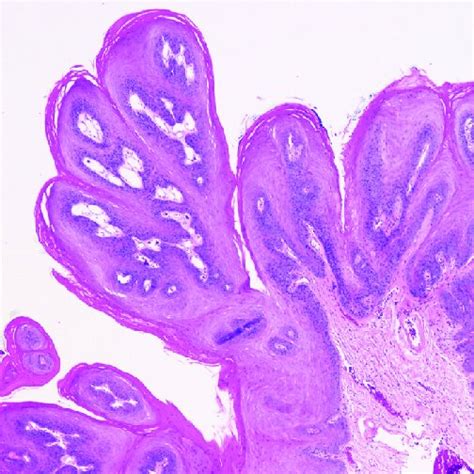 Clinical Presentation Of A Squamous Papilloma On The Ventral Tongue Download Scientific Diagram