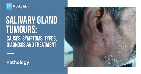 Salivary Gland Tumours Causes Symptoms Types Diagnosis And Treatment