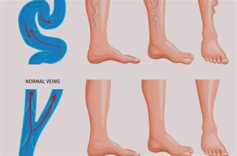 Manual para melhorar a circulação sanguínea nas pernas Clinica Veins