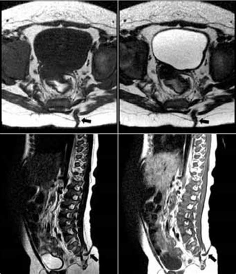 Preoperative Axial And Sagittal T1 Weighted And T2 Weighted