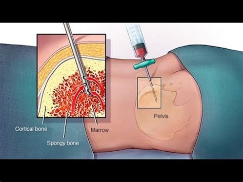 Aspirado De Medula Osea 2023 YouTube