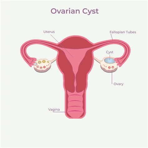 Understanding Ovarian Cysts: Symptoms, Types, and Treatment – Coach M