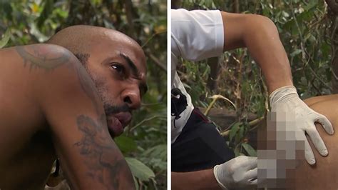 Naked And Afraid Contestant Has Stitches Removed From Butt