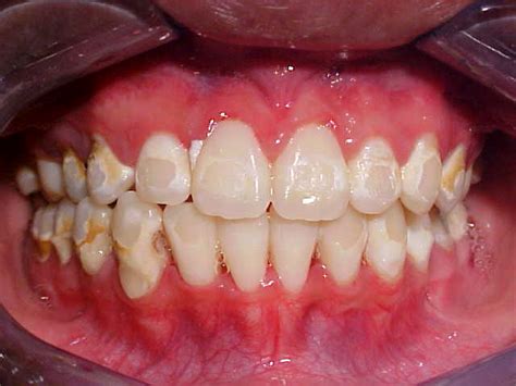 Complications And Risks For Braces Save A Smile Dental Clinic