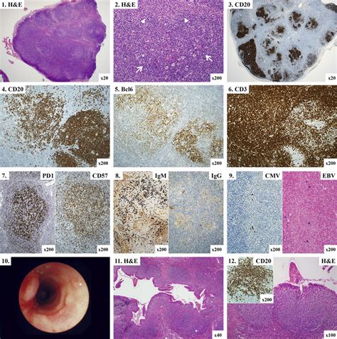 Lymphoid Hyperplasia 1 And 2 Lymph Node Showing Atypical Follicular Download Scientific